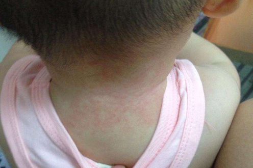 热痱子图片 来自搜狐网