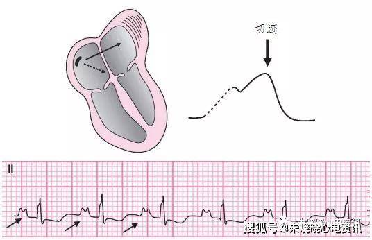 p波异常心电图口诀