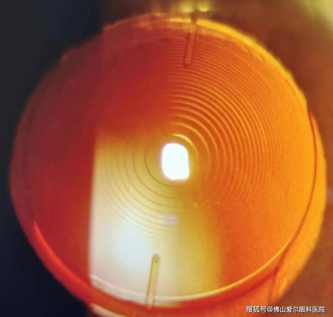 散光多焦点晶体让患者带来神奇视力，选择比努力更重要！-搜狐大视野-搜狐新闻