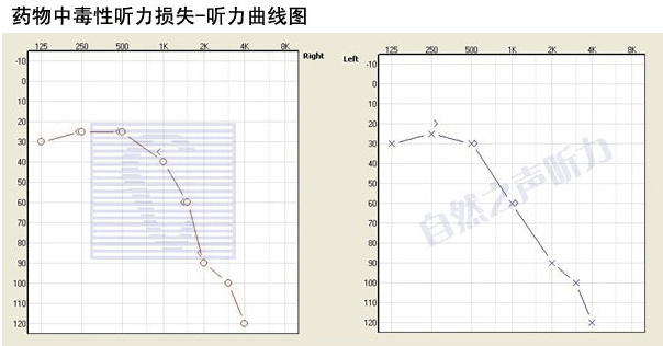 中青年听力损失的特点分析