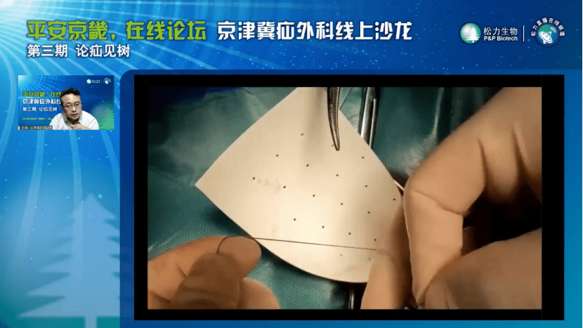 朝阳医院王帆教授进行松力生物补片修补手术视频演示生物补片的适用