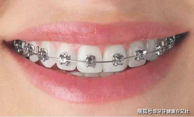 2.方形金属自锁牙套