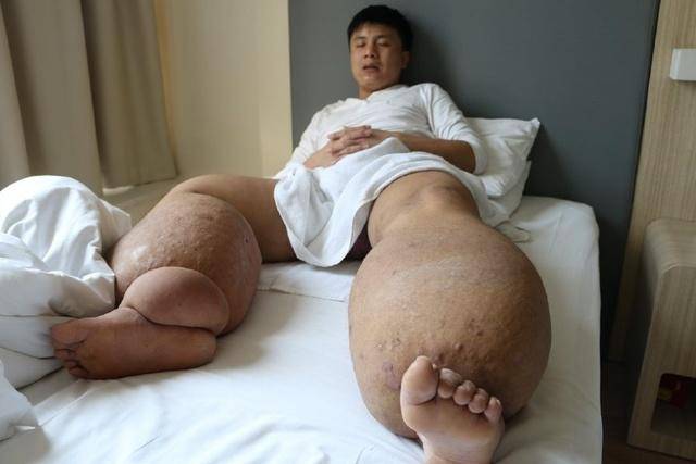 这位小伙子名叫刘中秋,他得了世界罕见疾病丝虫病,俗称大象腿患者