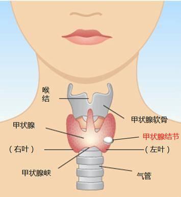 体检查出甲状腺结节怎么办,会恶化成甲状腺癌吗?一次给你说清