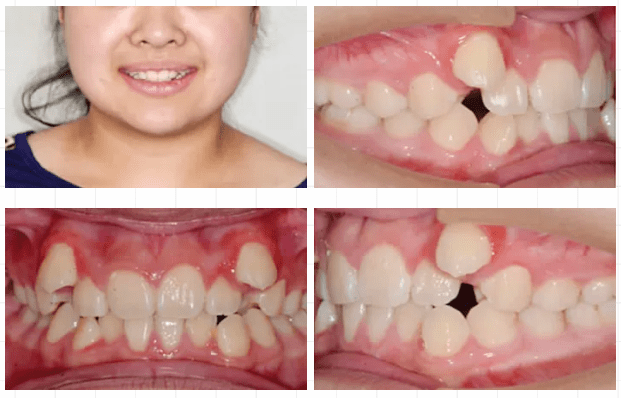 矫正牙齿医院排名_去医院矫正牙齿(3)