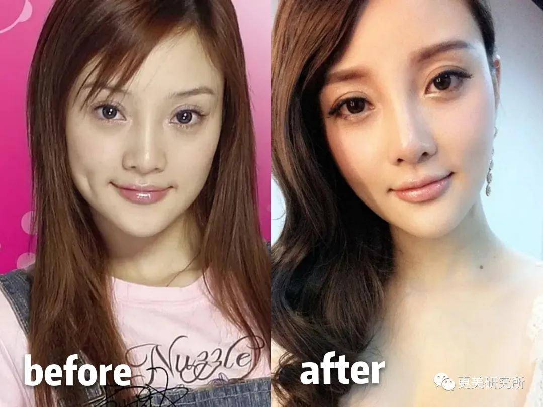 (△微微缩鼻头鼻尖效果) 像李小璐,既缩了鼻子宽度又削了骨,完全摒弃