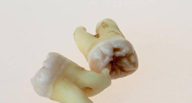 牙齿缝隙变大的原因 d8676bb35d6e473fa3947ea97fda0ffb.jpeg