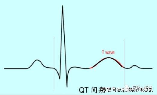 正常心电图波形及临床意义