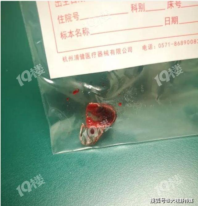 小时|整整手术7小时才取出！这东西几乎家家都有杭州一孩子吞食异物271个小时