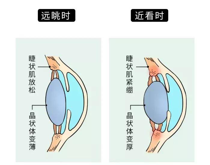 在我们用眼的时候,眼睛里的睫状肌会绷紧开展工作,它能够把晶状体挤