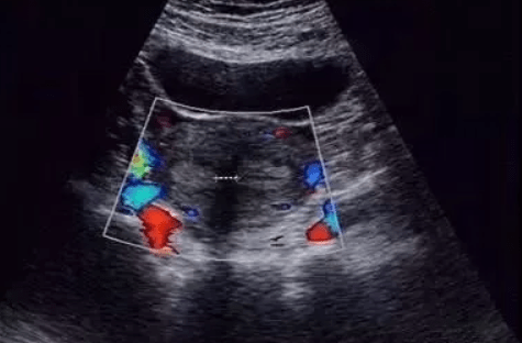 縱膈子宮可以懷孕嗎？縱膈子宮危害有哪些？《網路文章》