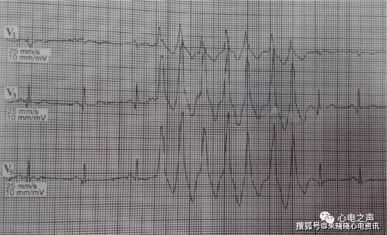 心动过速性电交替