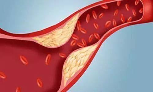 血脂怎样形成的 dcc60021c262449b8ba0fde08a3eddfc.jpeg