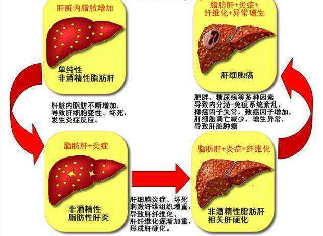 很多人说脂肪肝不是病,真的是这样吗?