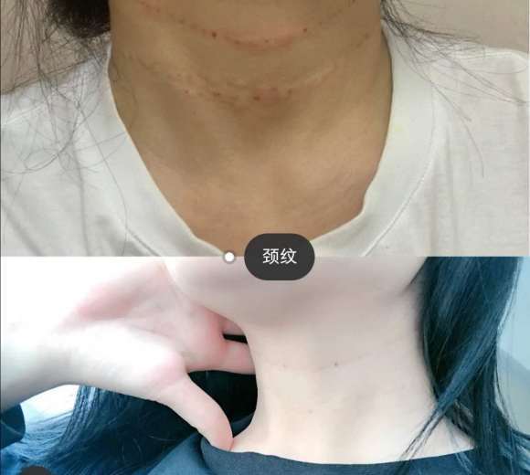 嗨体去颈纹副作用要讲