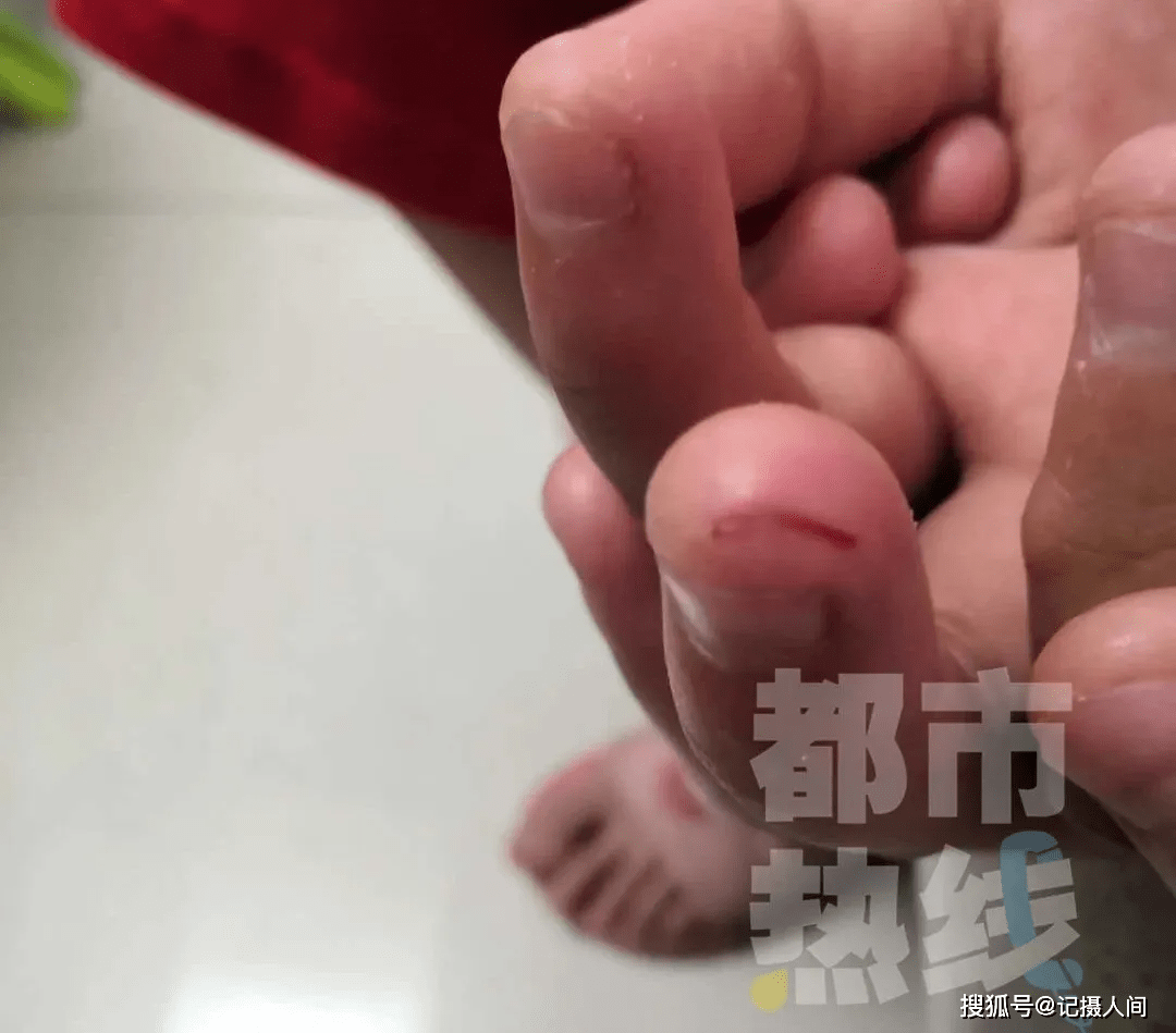 西安9岁女孩猫店“撸猫”手指破裂 被诊断为猫抓伤三级暴露