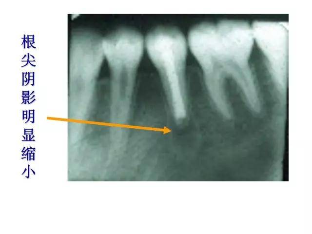 根尖诱导成形术(多图)