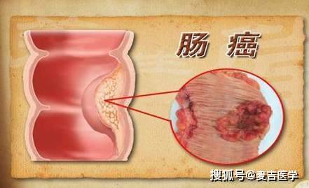 人人害怕的结直肠癌,医生说:做好预防和提前检查,并不