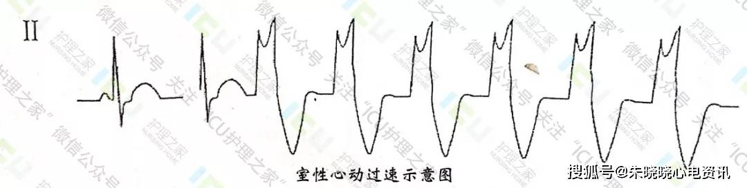 2短阵室性心动过速 是由三个以上连续出现的室性早搏形成,频率范围较