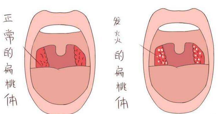 扁桃体发炎牙龈肿痛怎么办