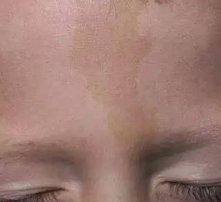 孩子各种胎记、血管瘤、斑、痣全面分析！