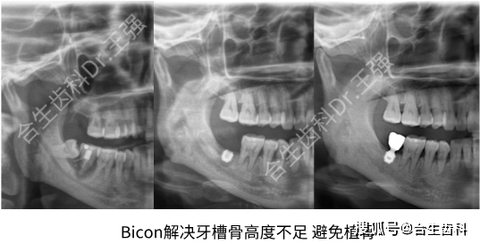 牙槽骨吸收还能种植牙?-合生齿科dr.王强