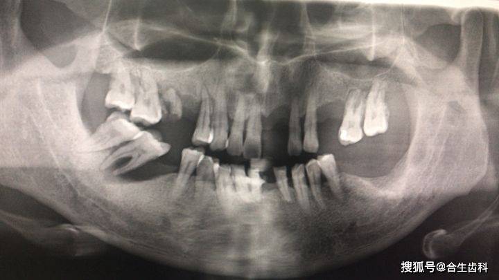 牙槽骨吸收还能种植牙?-合生齿科dr.王强