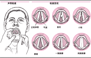 为民众着想的放心医院|武汉仁安眼耳鼻喉医院带你认识声带白斑