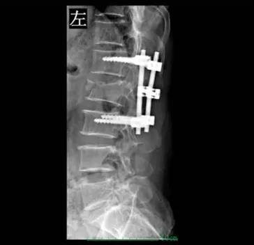 为患者在全身麻醉下行腰椎切开复位钉棒系统固定术 椎管减压术,手术