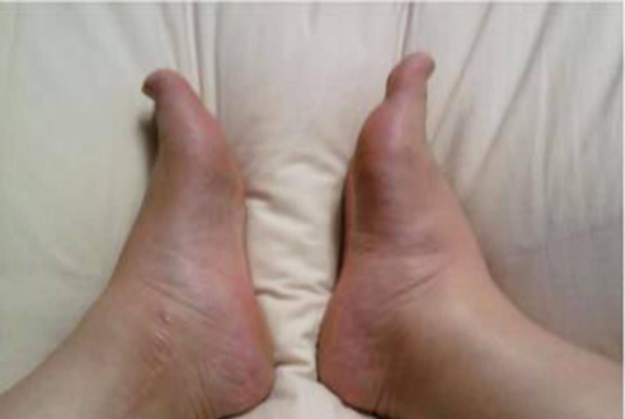原创怀孕后脚肿,腿肿,全身肿?孕水肿缓解"四妙招",效果立竿见影