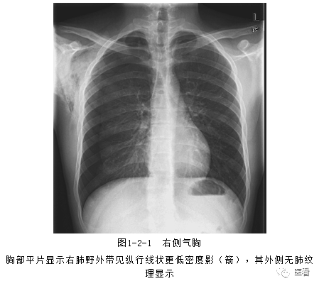 ② 胃肠道空腔脏器穿孔的患者x线上可以看到膈下游离气体(图1-2-2)