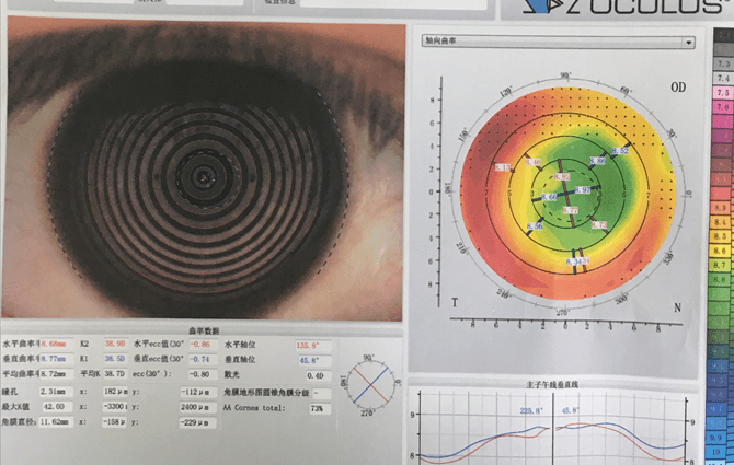 高度屈光参差,角膜屈光术后|配戴目立康安氧视rgp的临床案例效果分析