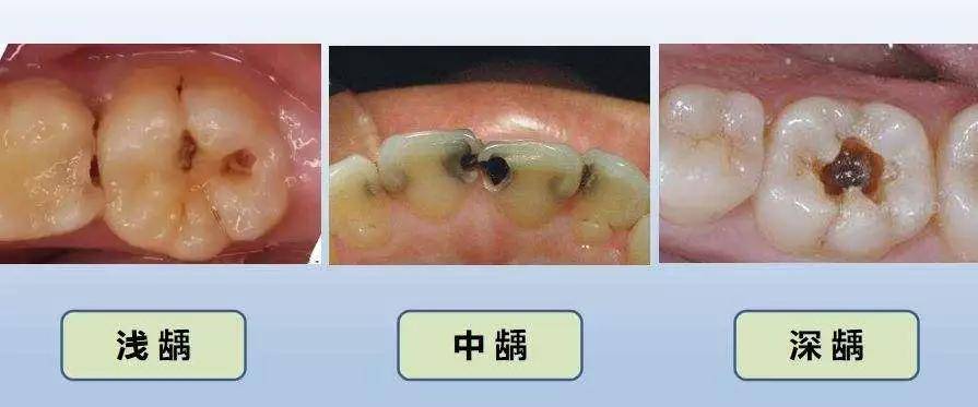 这个时候通常已经形成了蛀牙洞,治疗方法需要在牙洞上添加护髓剂再用
