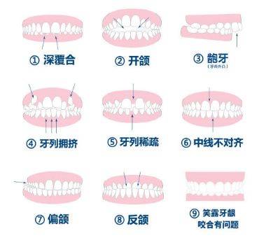 宝安儿童牙齿矫正的那些事情,你知道多少钱多久能完成