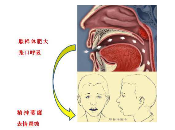 腺样体肥大的嘴唇图片,怎么治疗呢?一起来看看