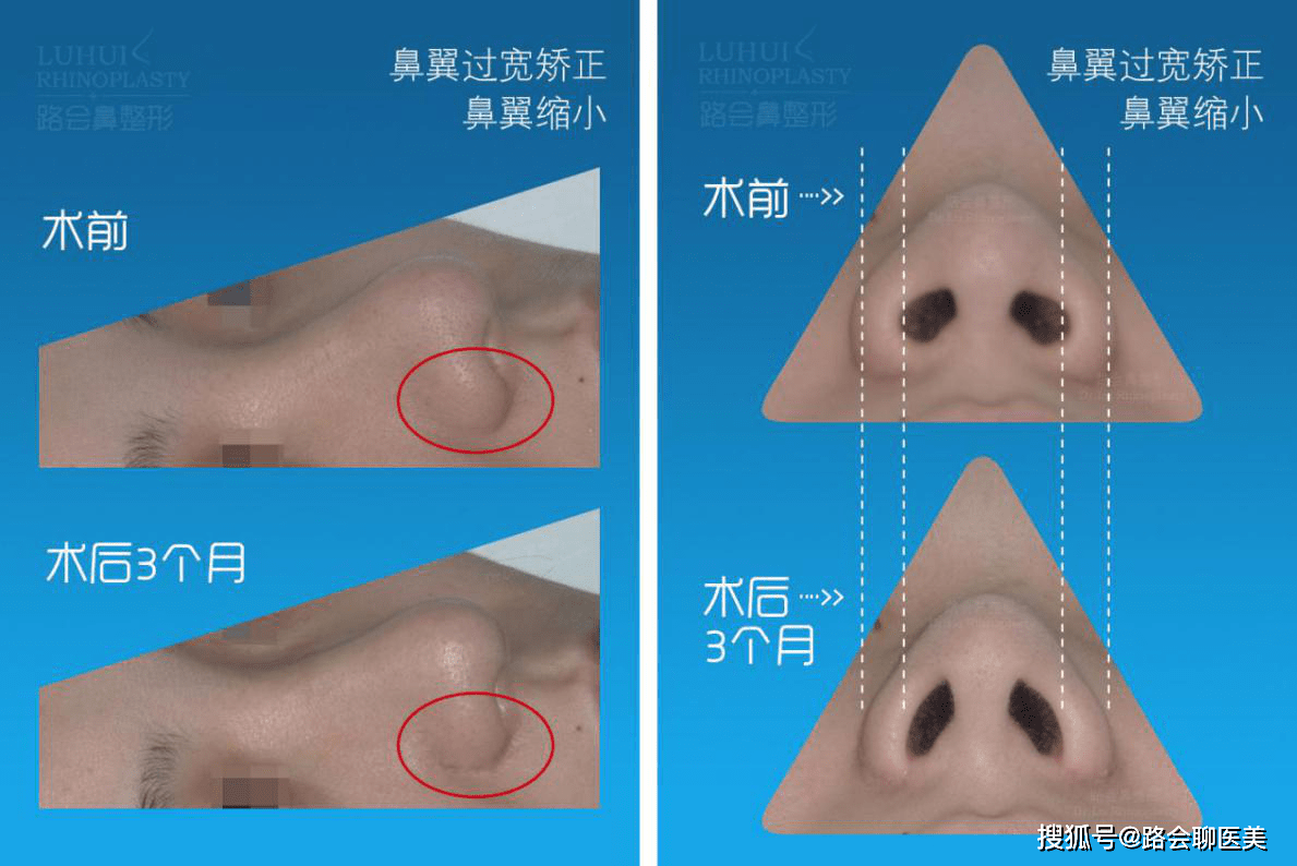 鼻翼大小不一样怎么办