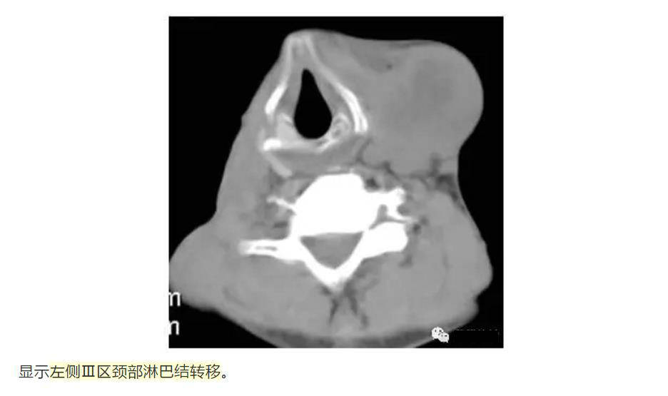 解剖颈部淋巴结分区精选资源