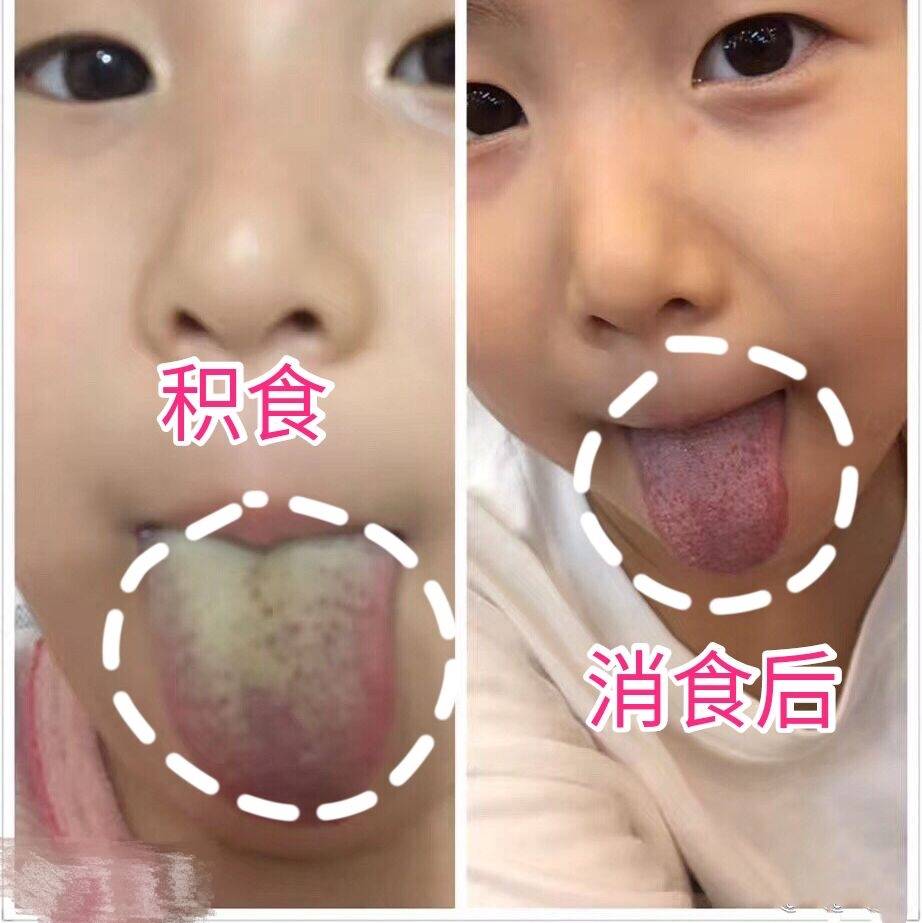 孩子|孩子积食有9大症状，看看自家孩子有没有