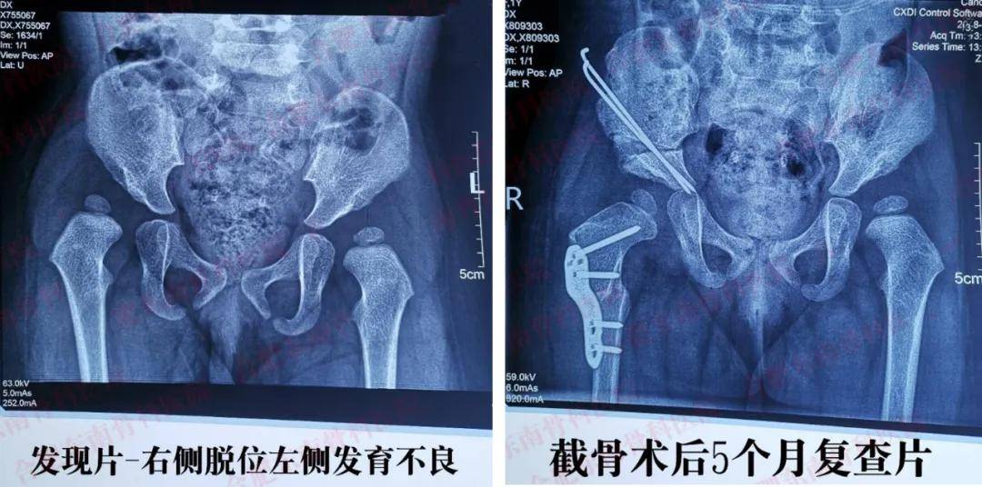 甘肃宝妈真情分享宝贝髋关节脱位求医经历,大爱传递保
