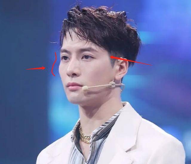 颧骨|王嘉尔变成牙套脸?颧骨外扩太阳穴也凹陷,太多明星因此颜值骤降