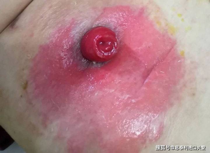夏季来临,如何做好造口周围皮肤护理?