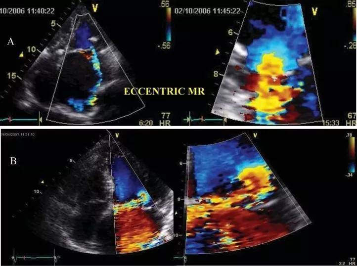 超声心动图十大基本功8.2:二尖瓣关闭不全的超声评估