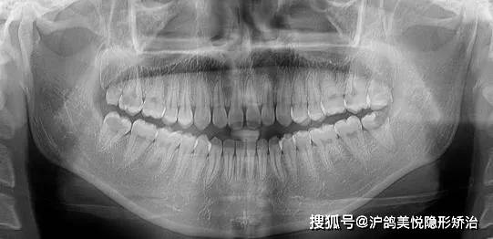 治疗前曲面断层片