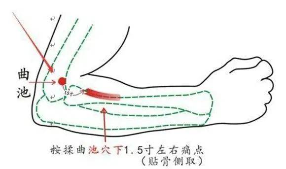 肘窝的曲池穴