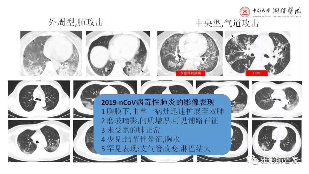 新冠肺炎的ct报告该怎么写?这几种规范可以参考