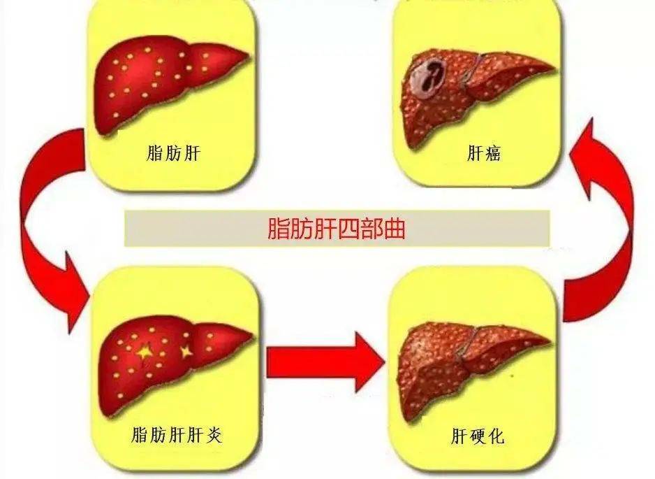 二,降低人体免疫功能,解毒功能:脂肪肝导致肝
