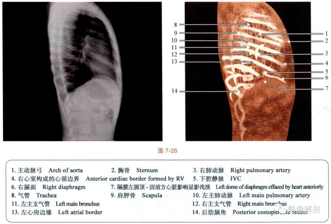 断层图谱:胸部ct冠状位解剖图谱