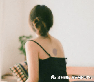 治疗|不要再对孩子胎记有误解了!济南童康儿童医院