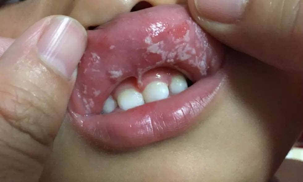 这就是鹅口疮,鹅口疮是婴儿常见的口腔疾病.