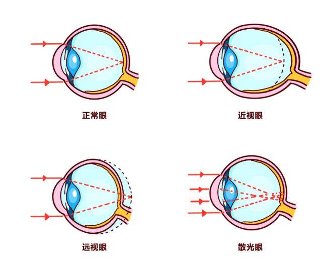 ③ 混合性近视:散瞳检验后近视屈光度可以降低但不能恢复.